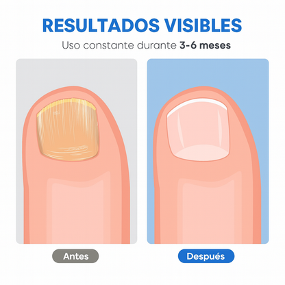 Dermolux™ | Tratamiento Antihongos Profesional En Casa 🦶💅